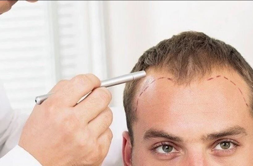 Why is Alcohol and Smoking Not Allowed Before Hair Transplant?